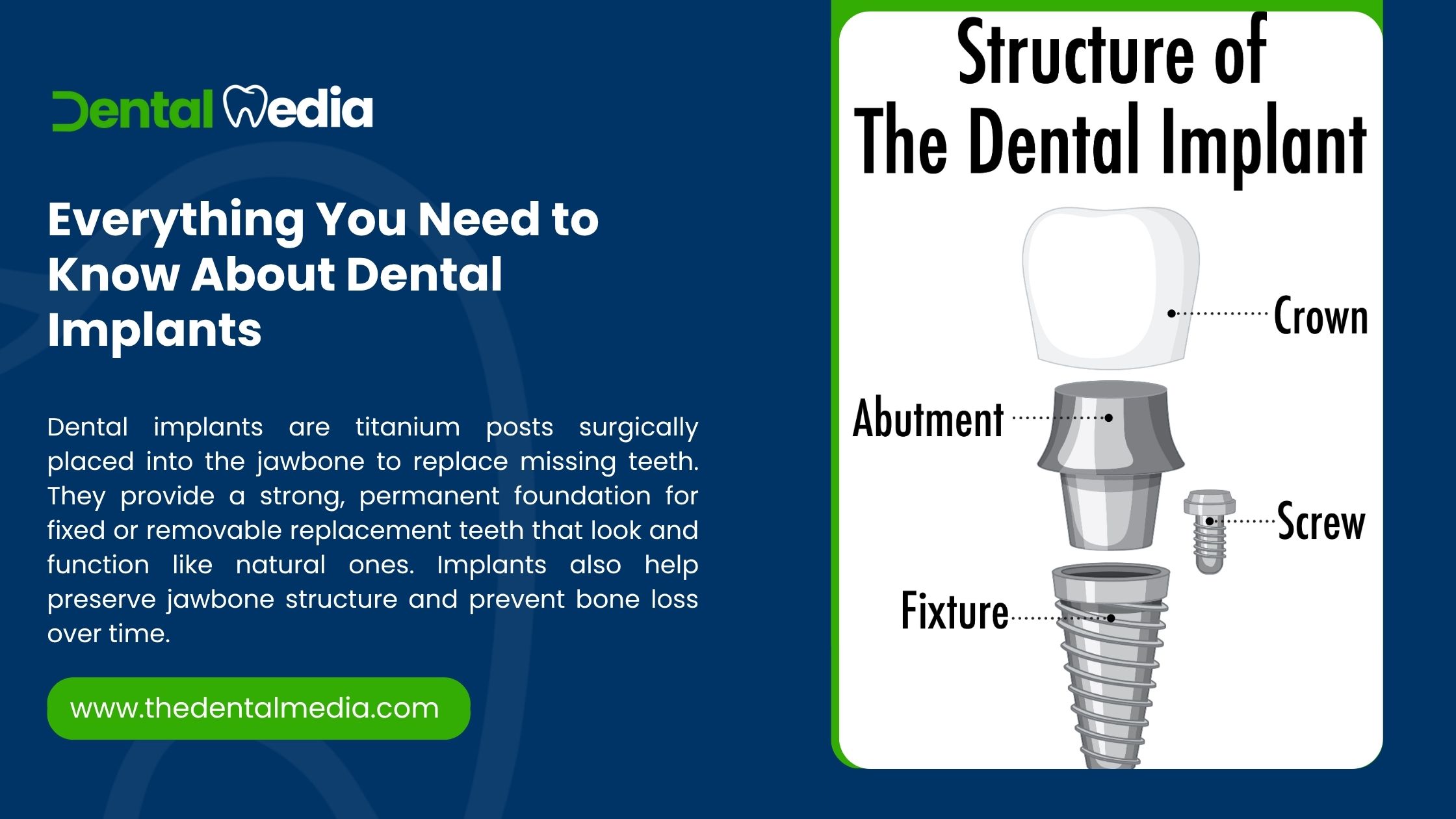 Everything You Need to Know About Dental Implants