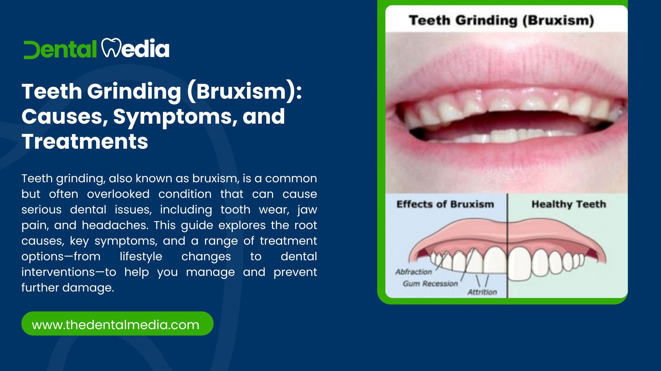 Teeth Grinding (Bruxism) Causes, Symptoms, and Treatments